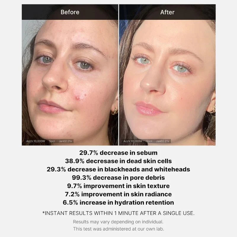 Medicube Red Acne Succinic Acid Peel Glow Crush Beauty