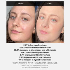 Medicube Red Acne Succinic Acid Peel Glow Crush Beauty